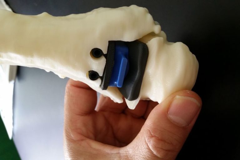 CAVIGLIA RICOSTRUITA IN 3D AL RIZZOLI DI BOLOGNA