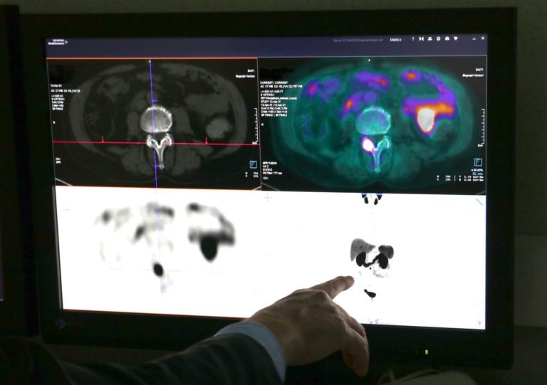 Tumore prostata, in uso nuovo radiofarmaco al “Cannizzaro” di Catania