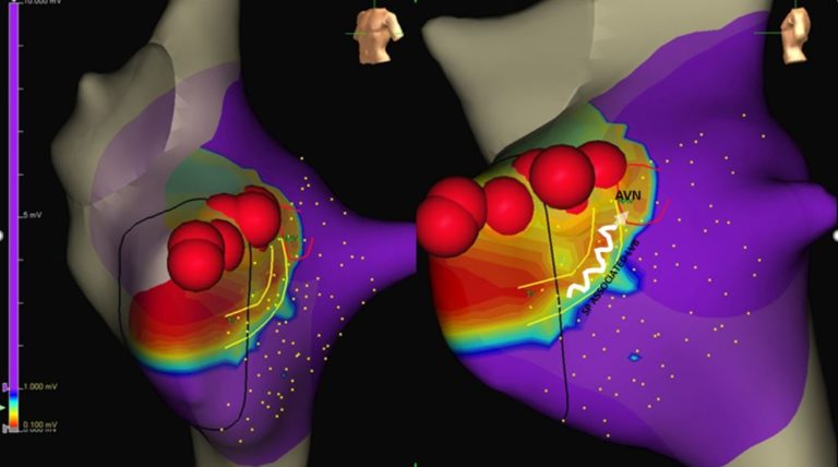 Una nuova tecnica di ablazione per le tachicardie pediatriche