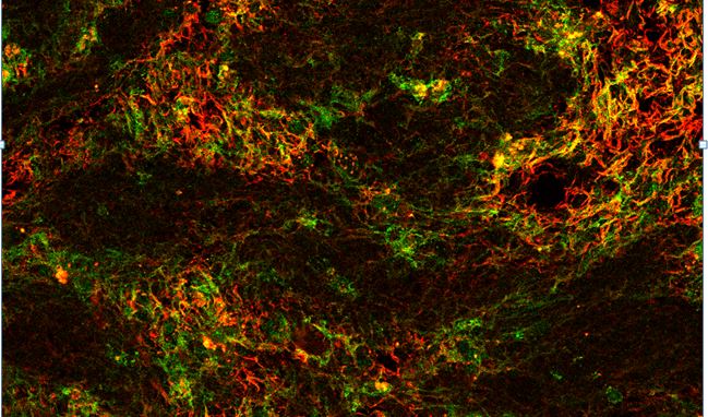 Sclerosi multipla, scoperto nuovo meccanismo di demielinizzazione