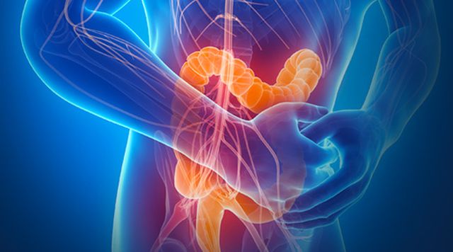Al Gemelli Pca per pazienti con infiammazione cronica intestinale