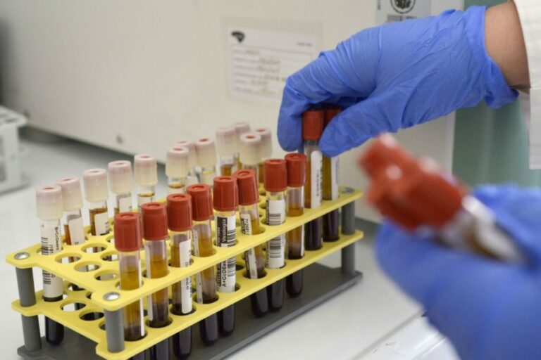 Covid, scoperti gli “autoanticorpi” che determinano i casi più gravi