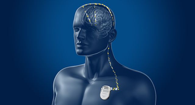 Parkinson, al Gemelli innovativa tecnica di neurostimolazione profonda