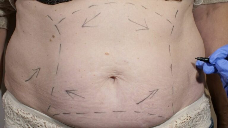 Eccessi cutanei post-dimagrimento, un aiuto dalla chirurgia plastica