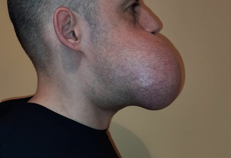 All’IRCCS Galeazzi-Sant’Ambrogio asportato ameloblastoma di 1,4 kg