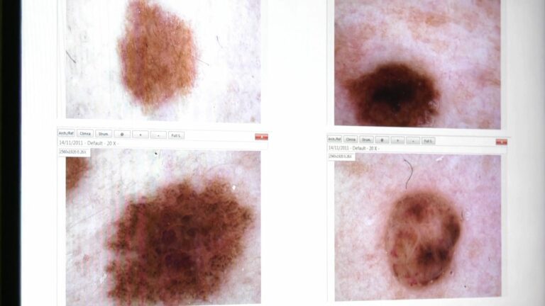 Melanomi e altri tumori della pelle, i consigli dell’esperto