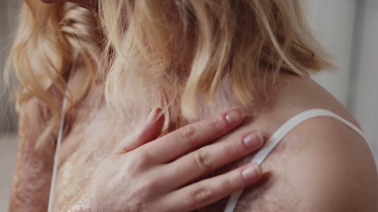 Rimedi alle ustioni, cruciale l’escarectomia selettiva precoce