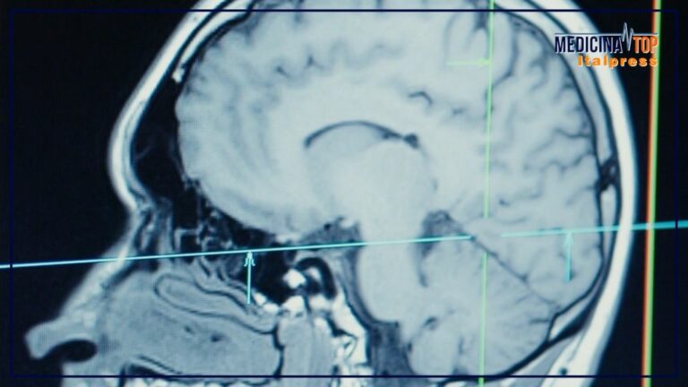 Ultrasuoni focalizzati, alta tecnologia al servizio della neurochirurgia