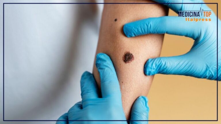 Passi avanti nella cura del melanoma, presto il vaccino